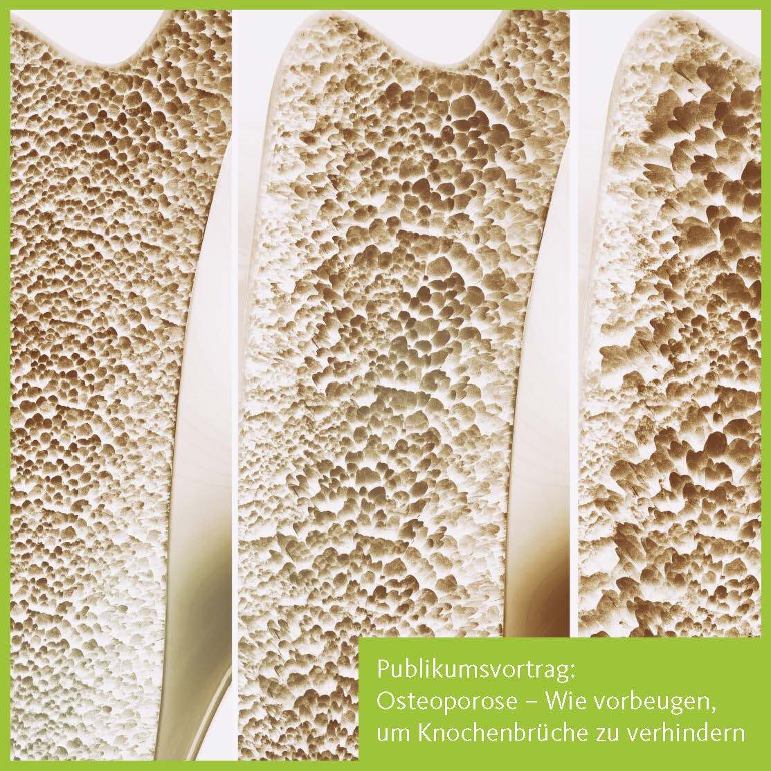 Publikumsvortrag Osteoporose
